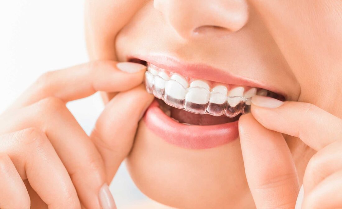 Saiba por que algumas pessoas usam aparelho invisível