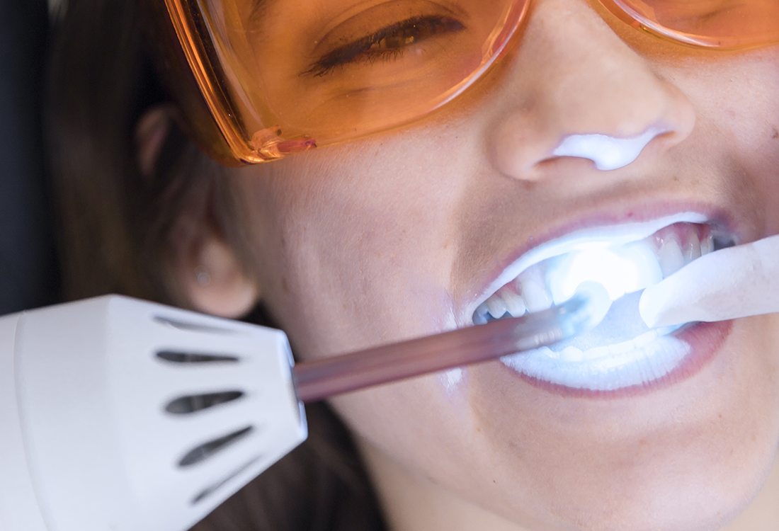 Mitos e verdades sobre clareamento dental